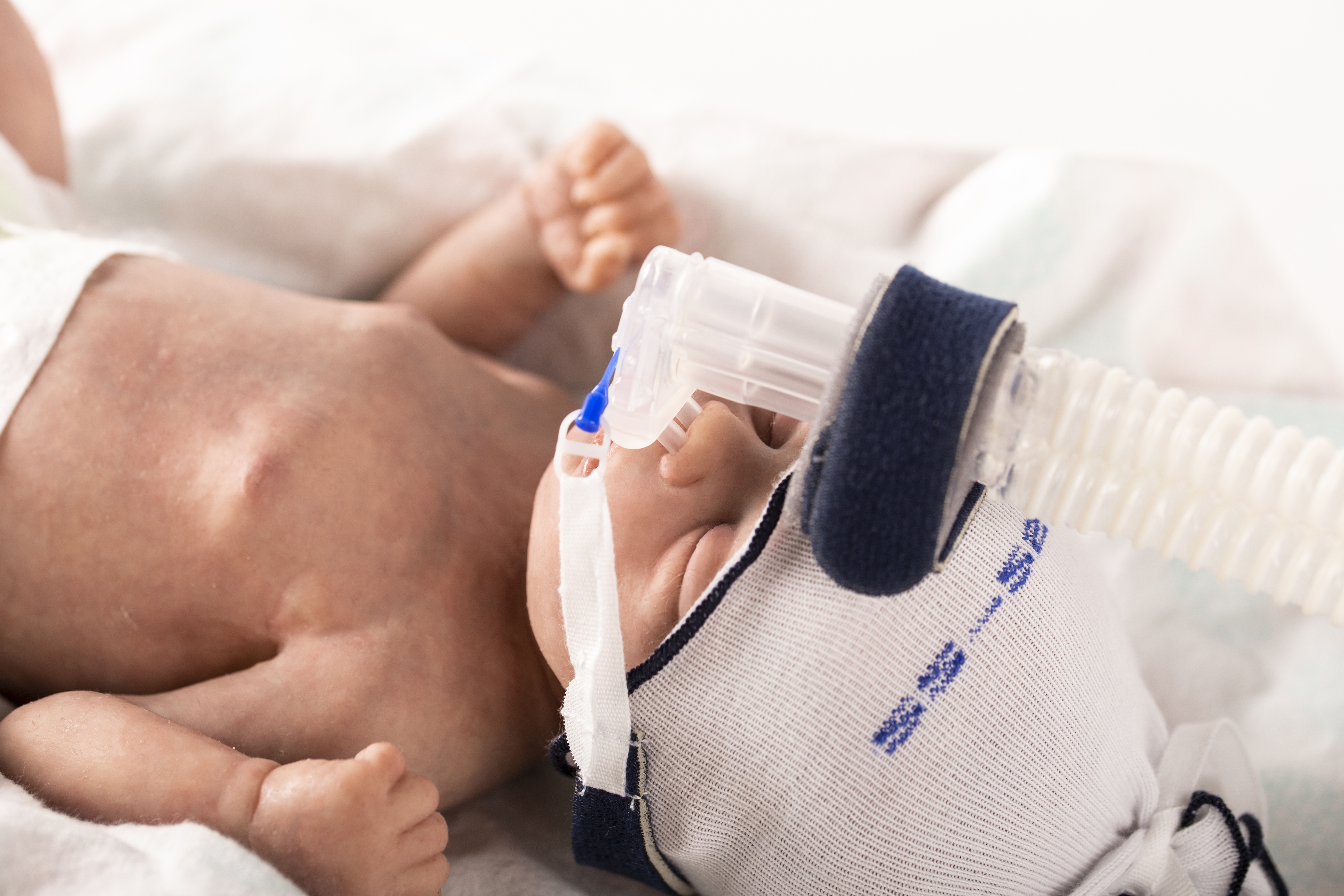 Webinar: Nasal CPAP in Neonates